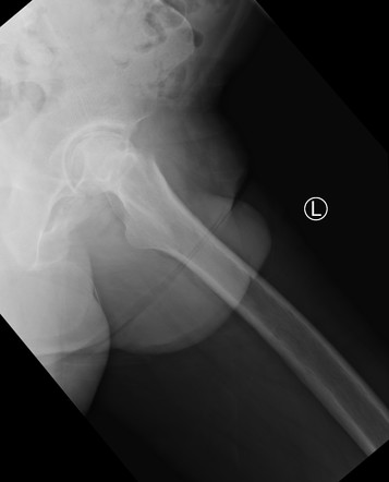 Crescent sign of osteonecrosis | Radiology Reference Article ...