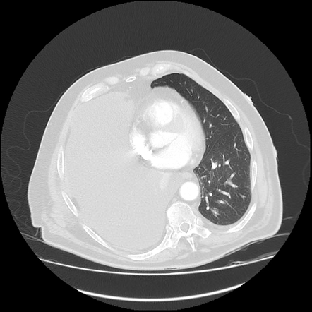 Malignant Pleural Effusion Image Radiopaedia Org