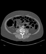 Computed Tomographic Ct Colonography Radiology Reference Article Radiopaedia Org