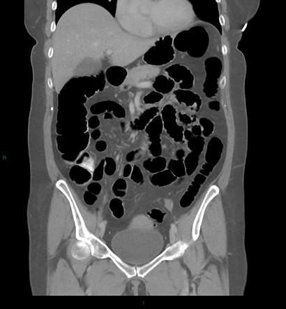 Diverticulosis (CT colonoscopy) | Image | Radiopaedia.org