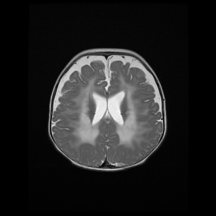 hypoxic ischemic encephalopathy in adults