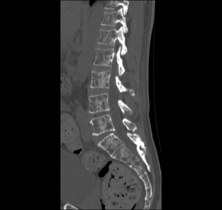 Lytic bone metastases | Radiology Reference Article | Radiopaedia.org