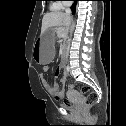 Mass forming cholangiocarcinoma | Image | Radiopaedia.org