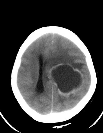 Hemorrhagic cerebral metastases | Radiology Case | Radiopaedia.org