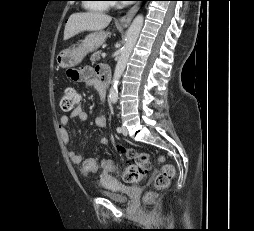 Stercoral Colitis With Perforation Image 7791