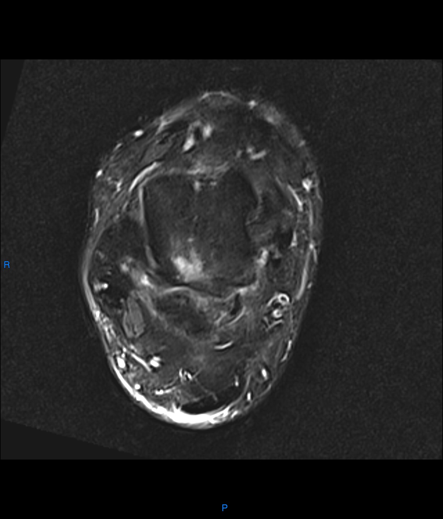 Posterior ankle impingement (Os trigonum syndrome) | Image ...