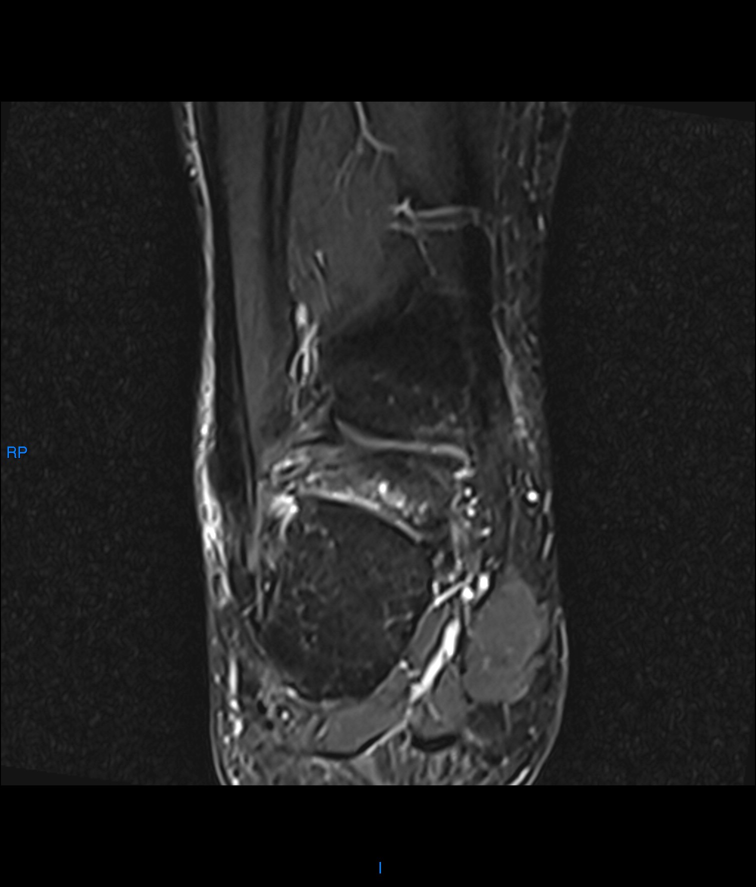 Posterior Ankle Impingement (Os Trigonum Syndrome) | Image ...