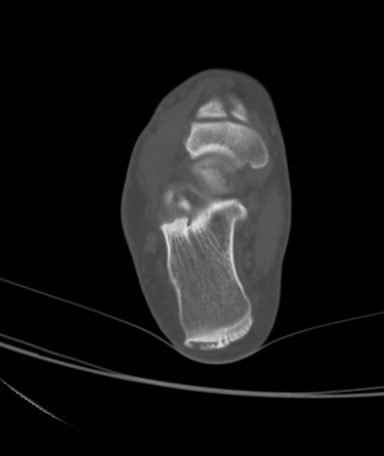 Posterior Ankle Impingement (Os Trigonum Syndrome) | Image ...