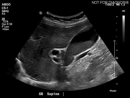 symptomatic gallbladder stone icd 10