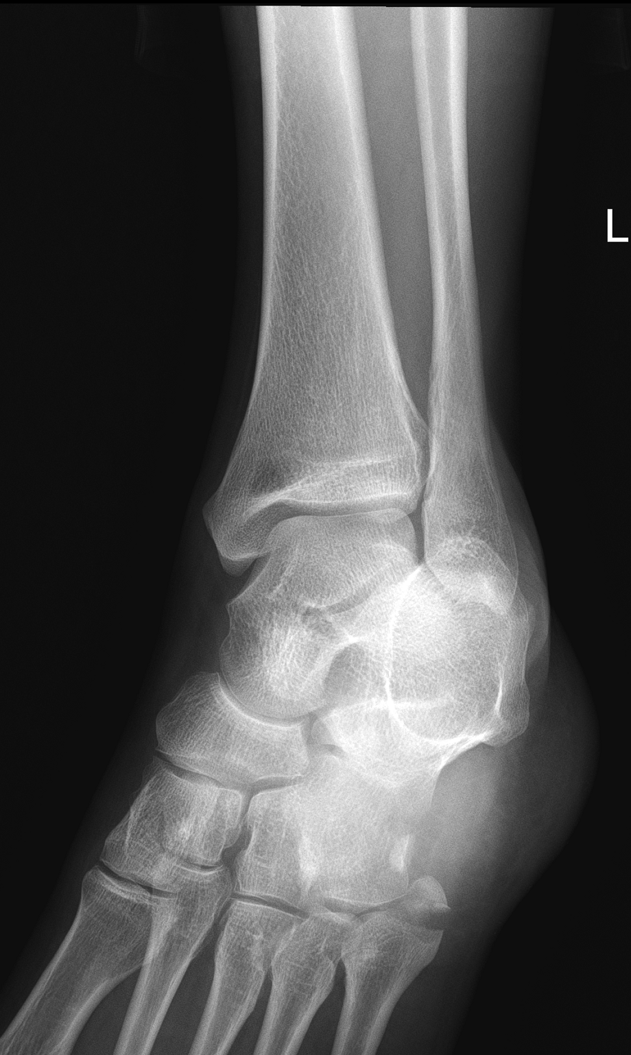 Avulsion Fracture Of The 5th Metatarsal Styloid Image