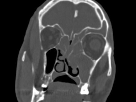 Sinonasal polyposis store