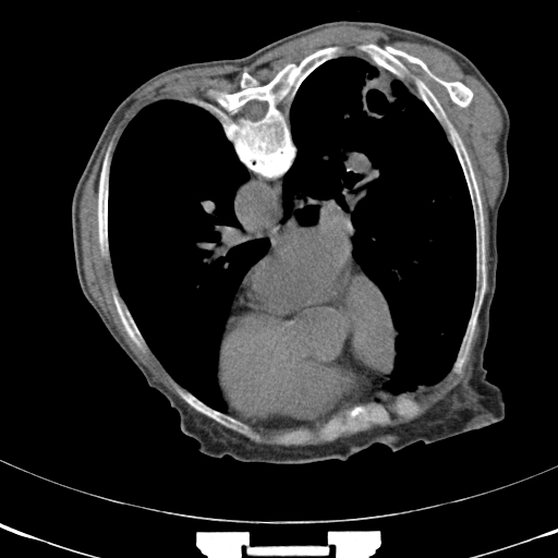 Tuberculous Cavity Aspergilloma 