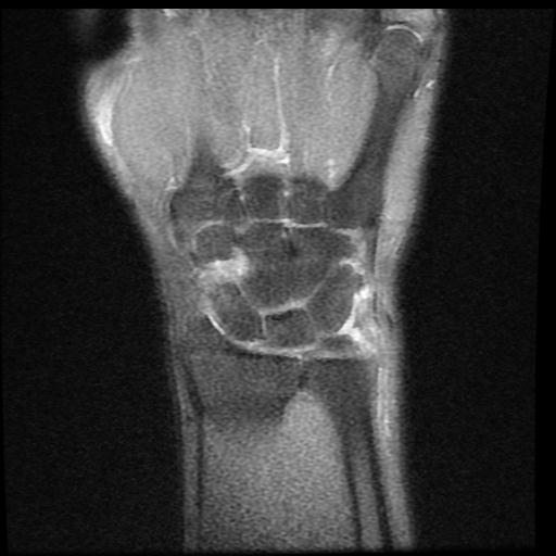 Isolated pisiform bone fracture (MRI) | Image | Radiopaedia.org