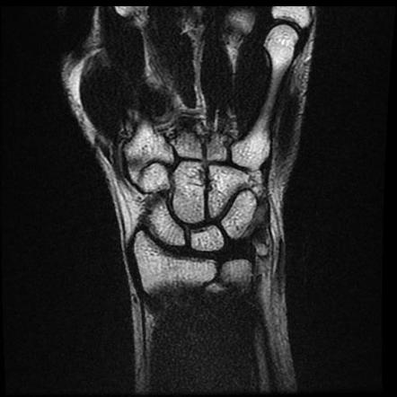 Isolated Pisiform Bone Fracture (MRI) | Image | Radiopaedia.org