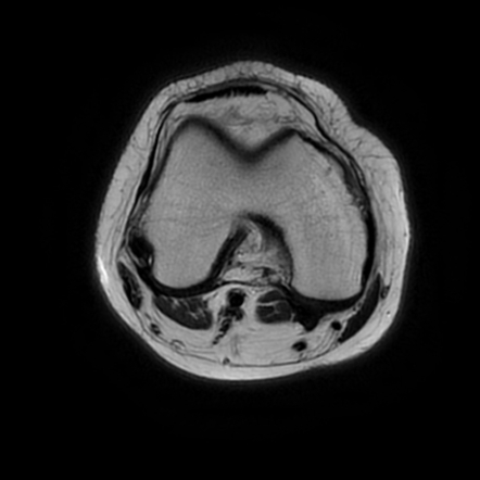 Growth arrest lines and physeal stress injury | Image | Radiopaedia.org