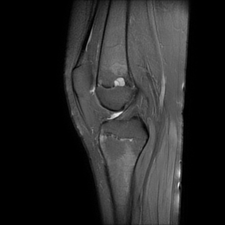 Growth Arrest Lines And Physeal Stress Injury 