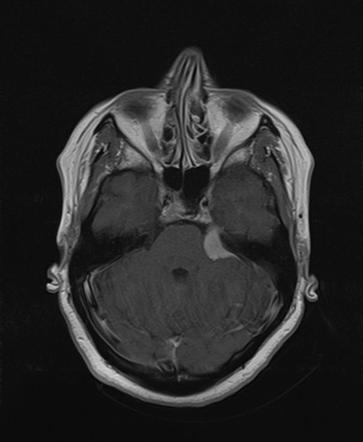 Frontal and cerebellopontine angle meningiomas | Radiology Case ...