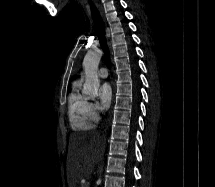 Arteria lusoria | Image | Radiopaedia.org