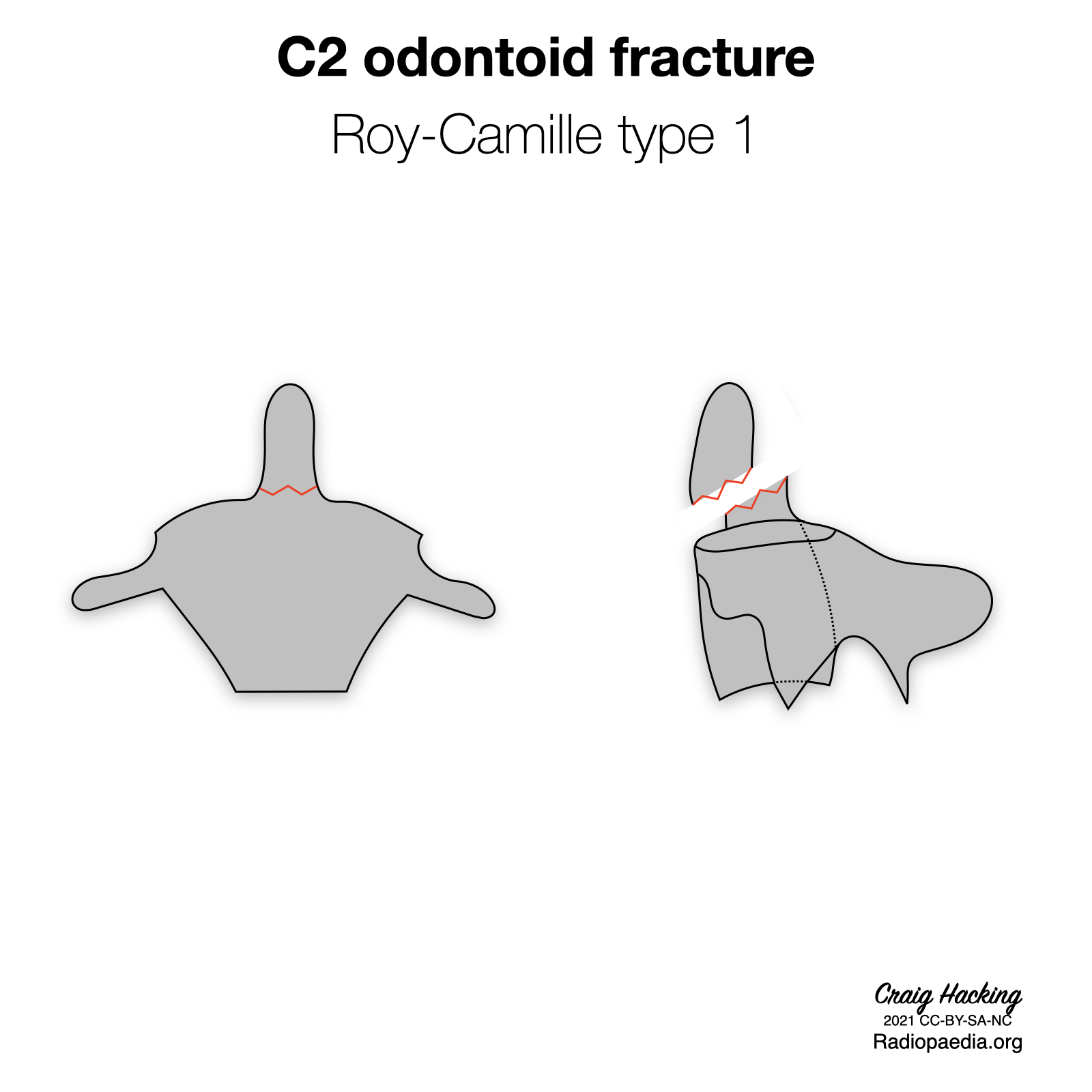 Roy-Camille classification of C2 odontoid fractures (diagrams) | Image ...