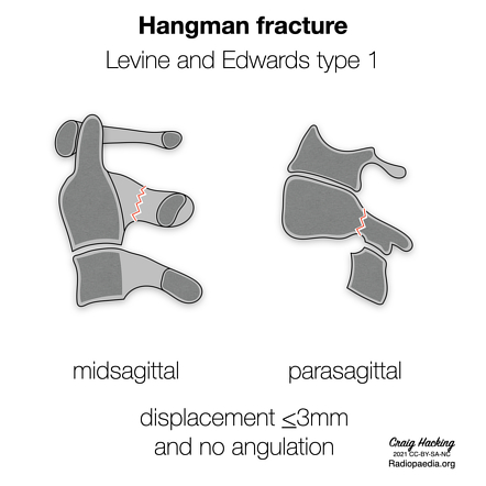 Odontoid and hangman fracture