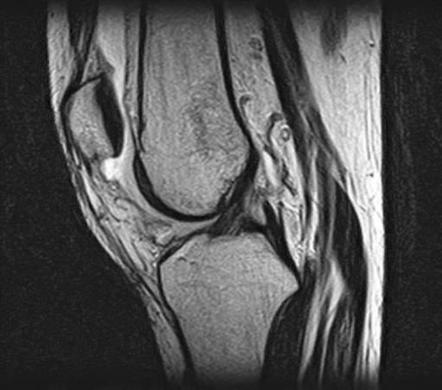 Transient lateral patellar dislocation | Image | Radiopaedia.org