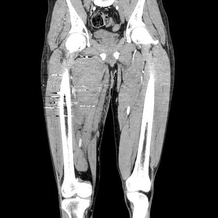 Femoral artery pseudoaneurysm | Image | Radiopaedia.org