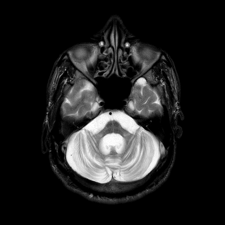 Multiple System Atrophy | Radiology Case | Radiopaedia.org