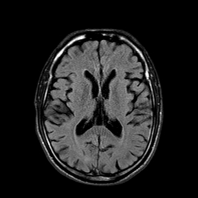 Multiple system atrophy | Image | Radiopaedia.org