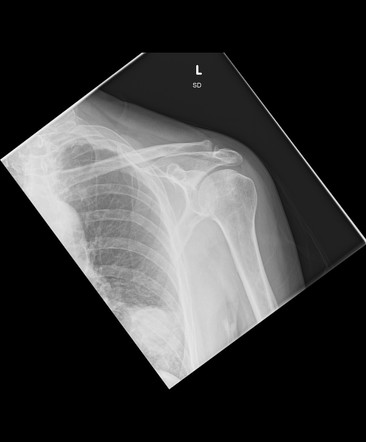 Lung Cancer | Radiology Case | Radiopaedia.org