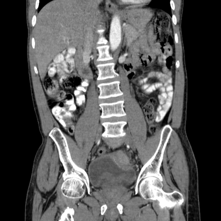 Squamous cell carcinoma of urinary bladder | Radiology Case ...