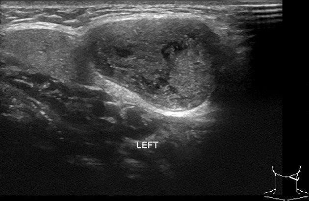 branchial cleft cyst ultrasound