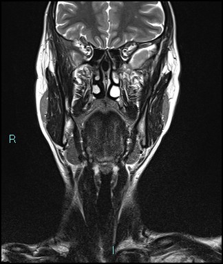 Cervical thymic cyst | Image | Radiopaedia.org