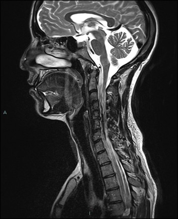 Cervical thymic cyst | Image | Radiopaedia.org