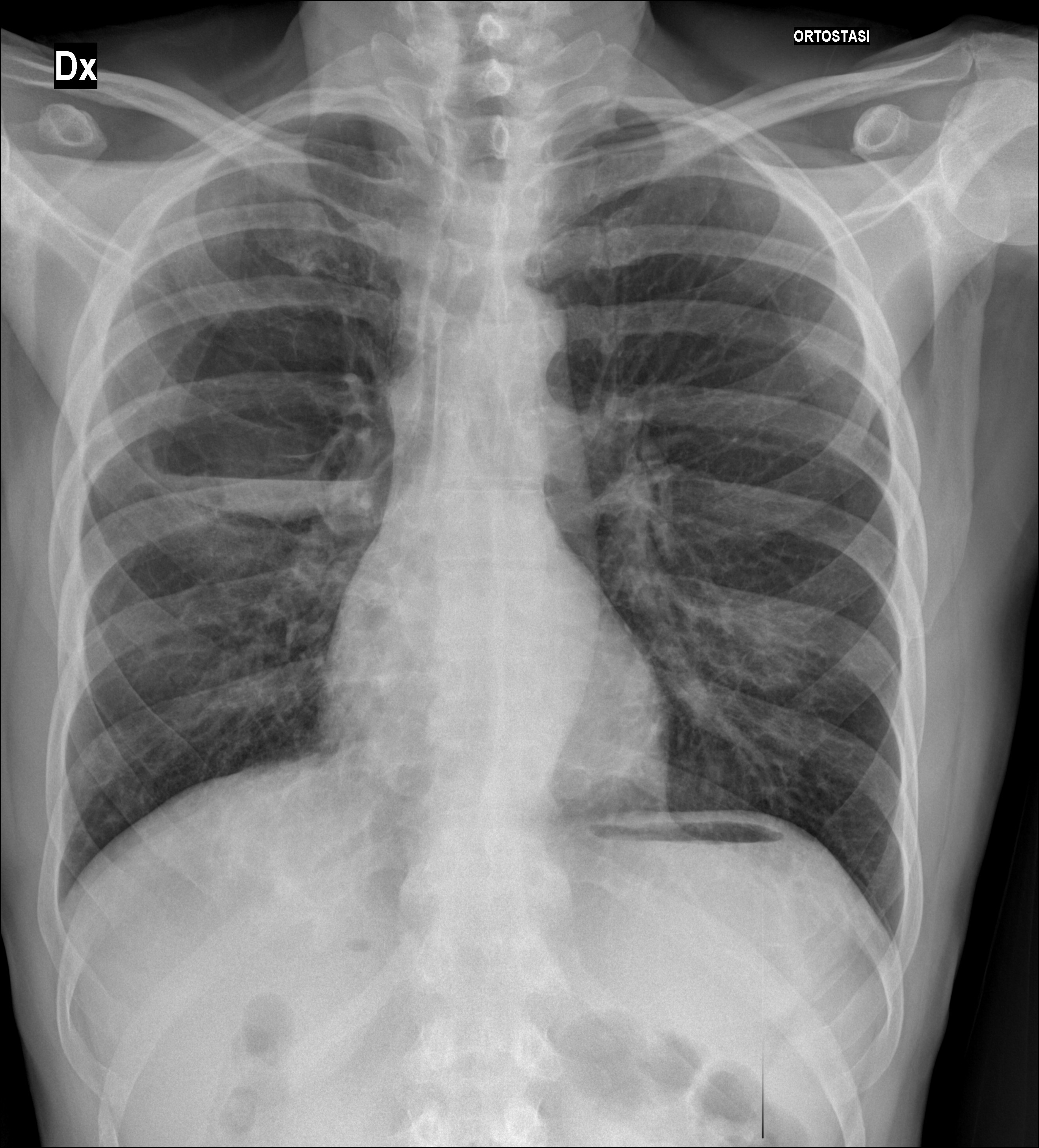 Post COVID-19 pneumatocele | Image | Radiopaedia.org