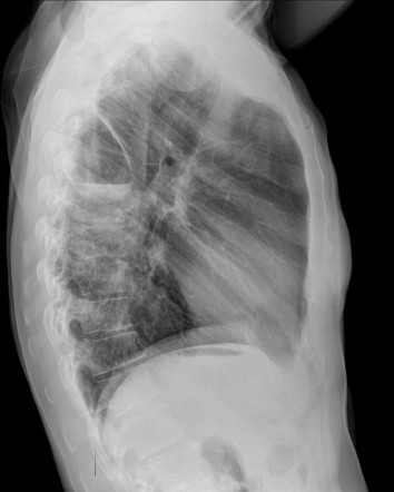 Post COVID-19 pneumatocele | Radiology Case | Radiopaedia.org