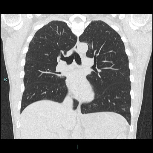 Post COVID-19 pneumatocele | Image | Radiopaedia.org