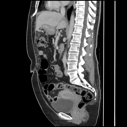 Signet ring cell gastric adenocarcinoma | Image | Radiopaedia.org