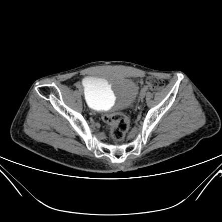 Squamous Cell Carcinoma Urinary Bladder Radiology Reference Article ...