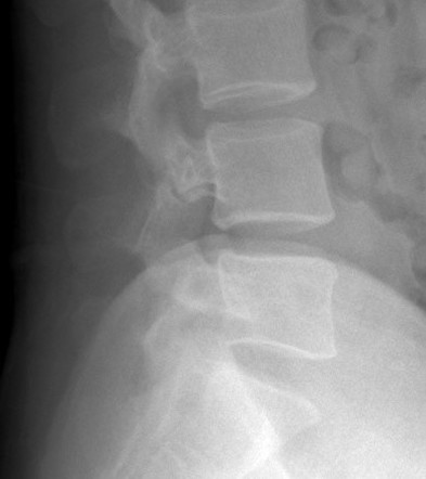 Pars interarticularis defect | Image | Radiopaedia.org