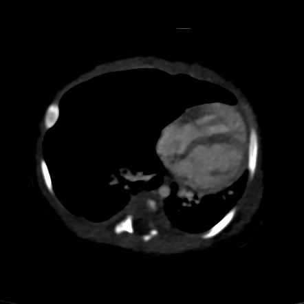 Congenital lobar emphysema | Radiology Case | Radiopaedia.org