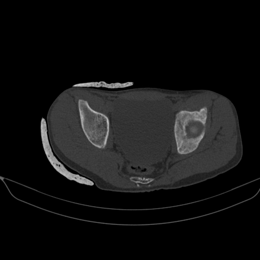 Anterior Inferior Iliac Spine Avulsion Injury Image