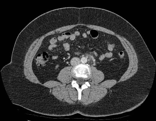 Sigmoid Diverticulitis Image 