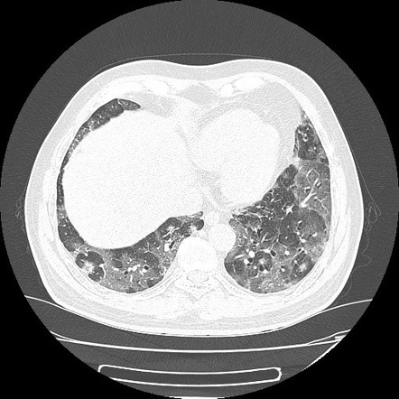 Pulmonary target sign - COVID-19 | Radiology Case | Radiopaedia.org