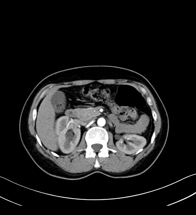 Multilocular cystic renal neoplasm of low malignant potential | Image ...