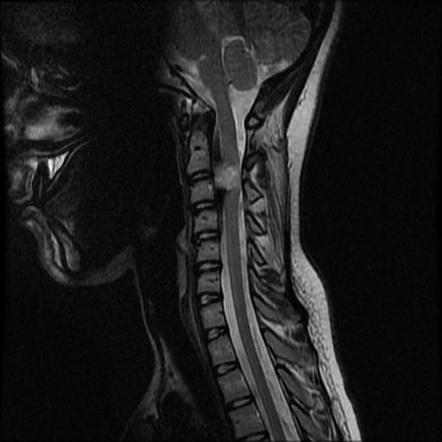 Cervical Nerve Sheath Tumor 