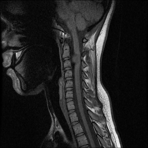 Cervical nerve sheath tumor | Image | Radiopaedia.org