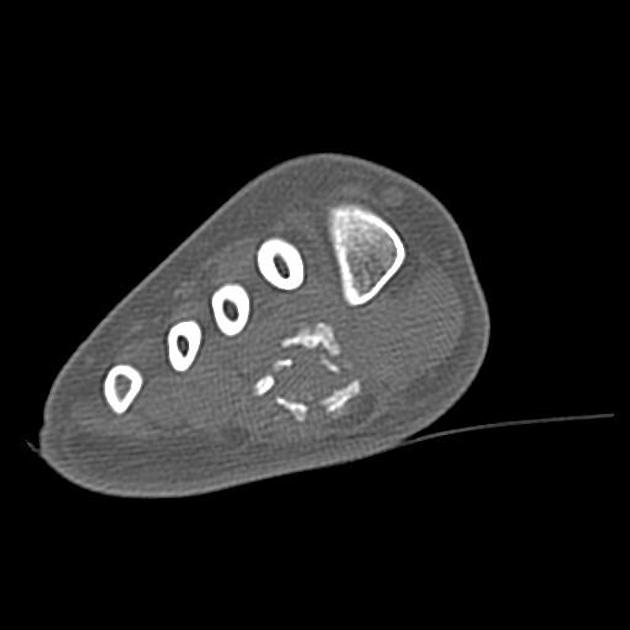 Florid reactive periostitis | Radiology Reference Article | Radiopaedia.org