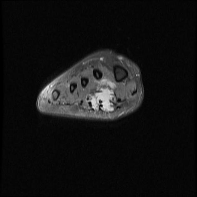 Florid reactive periostitis | Radiology Reference Article | Radiopaedia.org