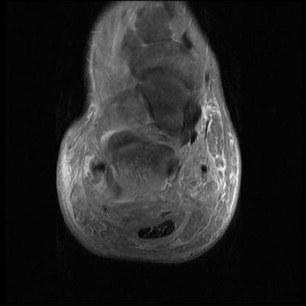 Osteomyelitis Calcaneus