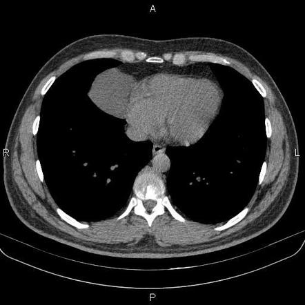 Pericardial cyst | Radiology Reference Article | Radiopaedia.org